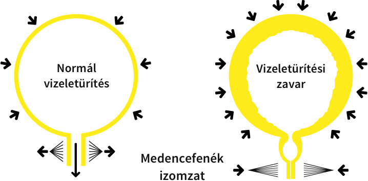 Normál vs vizeletürítési zavar